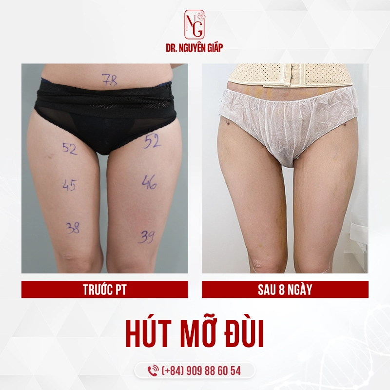 Hut-mo-dui-copy Hút mỡ đùi đem đến kết quả thon thả ấn tượng, hồi phục nhanh