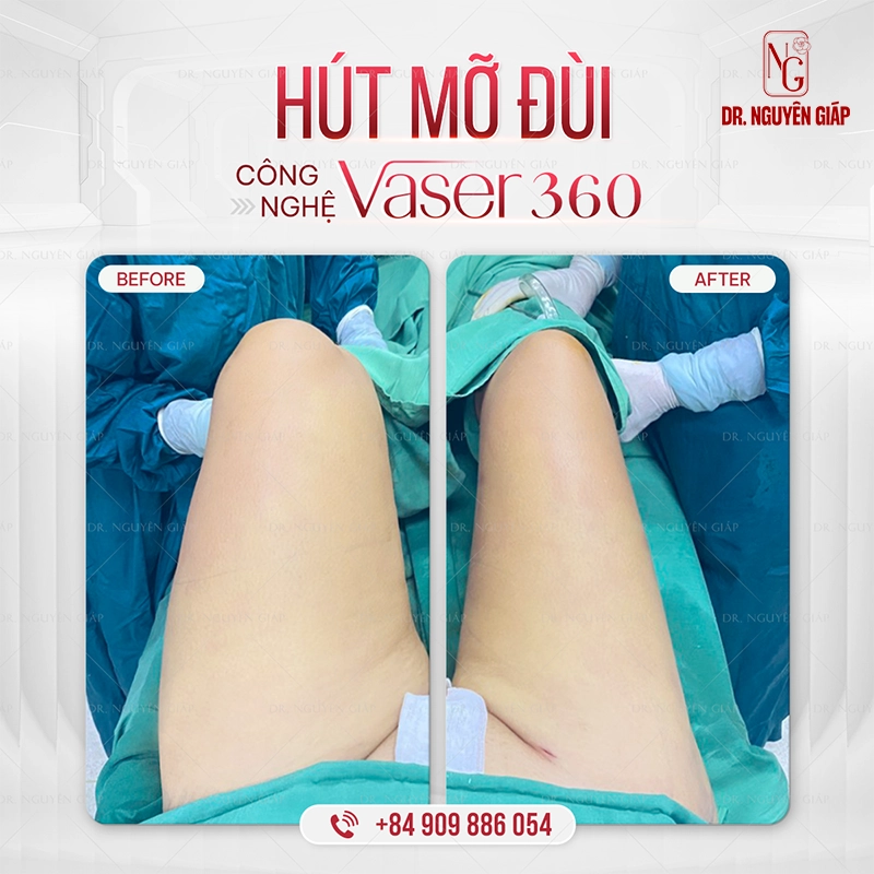 HÚT-MỠ-ĐÙI-BA2 Thon thả rõ rệt sau hút mỡ đùi