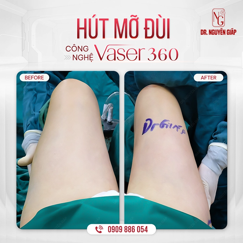 HÚT-MỠ-ĐÙI-BA1 Hiệu quả hút mỡ đùi rõ rệt ngay sau phẫu thuật