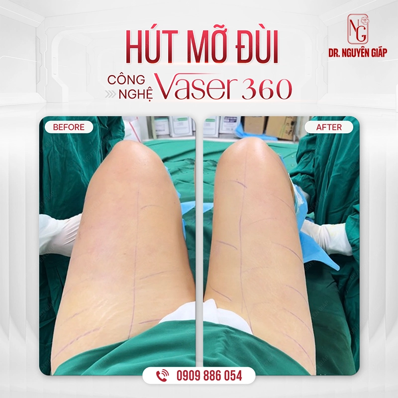 HÚT-MỠ-ĐÙI-BA Hiệu quả hút mỡ đùi rõ rệt ngay sau phẫu thuật