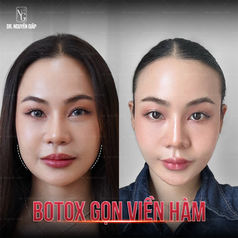 Tham-my-khong-phau-thuat-Tiem-botox-ham Tiêm botox còn có hiệu quả làm thon gọn viền hàm, nhan sắc thăng hạng