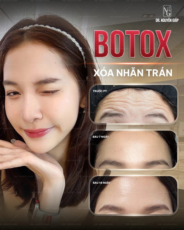 Thẩm mỹ không phẫu thuật - Tiêm botox xóa nhăn Hiệu quả xóa nhăn ấn tượng của botox