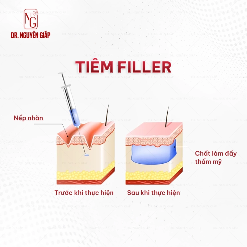 Tham-my-khong-phau-thuat-Tiem-filller Thẩm mỹ không phẫu thuật băng tiêm filler
