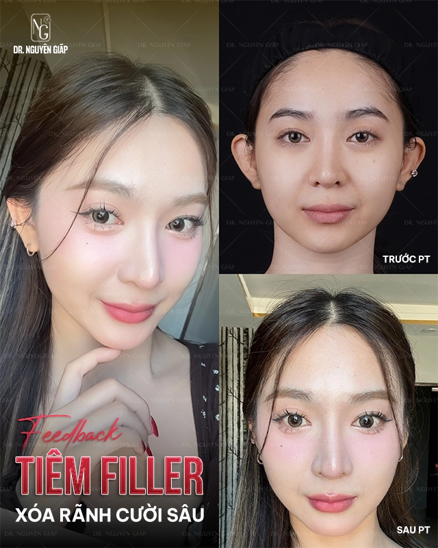 Tham-my-khong-phau-thuat-Tiem-filller-xoa-ranh-cuoi-sau Khách hàng thẩm mỹ không phẫu thuật - Tiêm filller xóa rãnh cười sâu