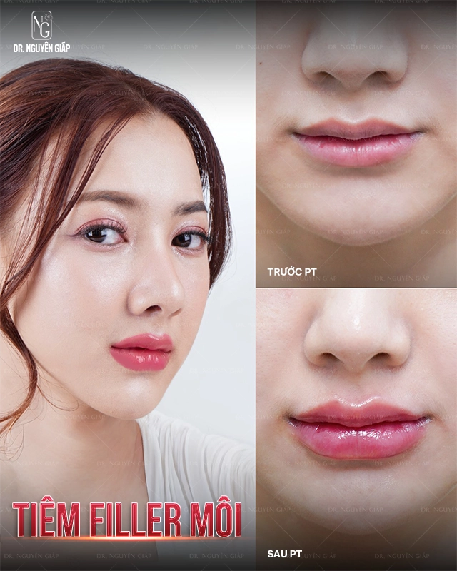 Thẩm mỹ không phẫu thuật - Tiêm filller Dáng môi cực đẹp và căng bóng sau khi tiêm filler