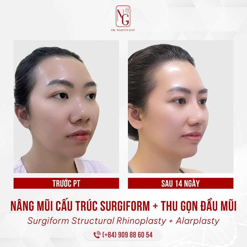Thu gọn cánh mũi giúp bạn sở hữu đường nét thanh tú hơn