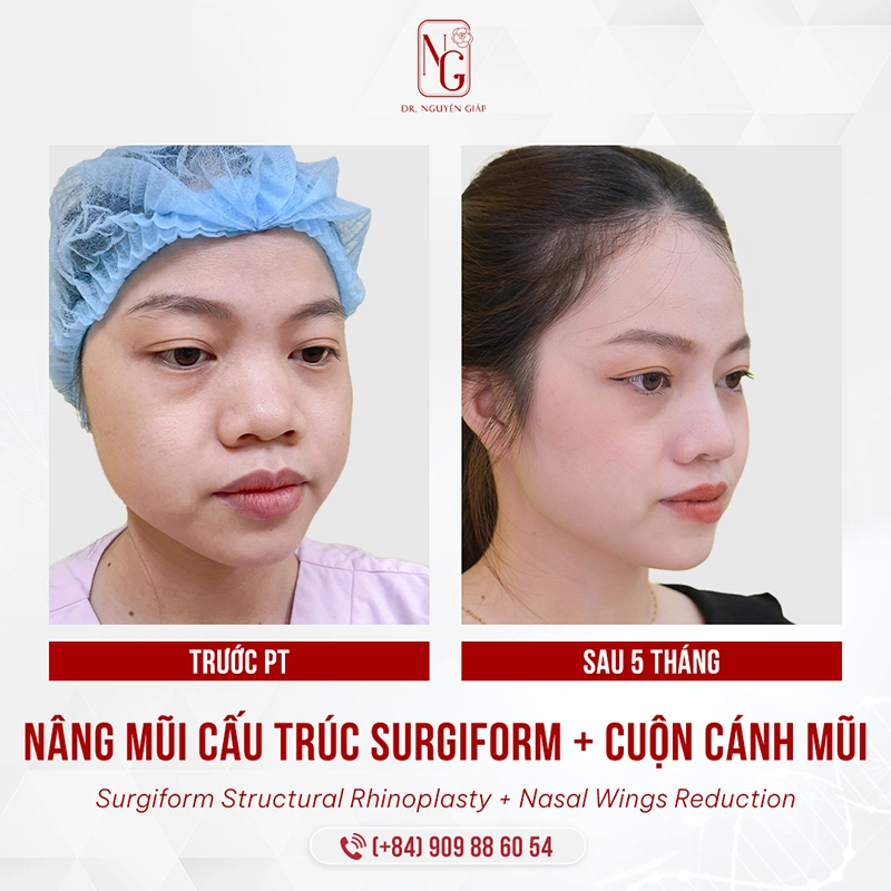 Thu gọn cánh mũi không để lại sẹo xấu