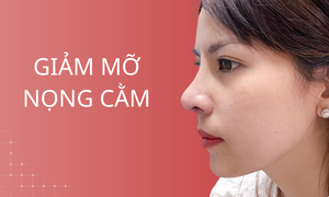 dich-vu-giam-mo-nong-cam
