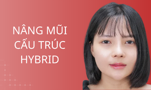 dich-vu-nang-mui-cau-truc