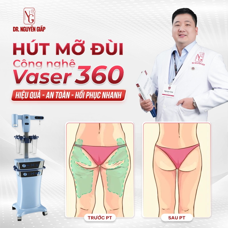 Dịch vụ hút mỡ đùi Vaser 360 nhẹ nhàng trong từng chuyển động Hút mỡ đùi Vaser 360 nhẹ nhàng thon thả trong từng chuyển động