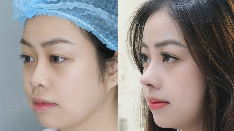 kep-nang-mui-co-hieu-qua-khong