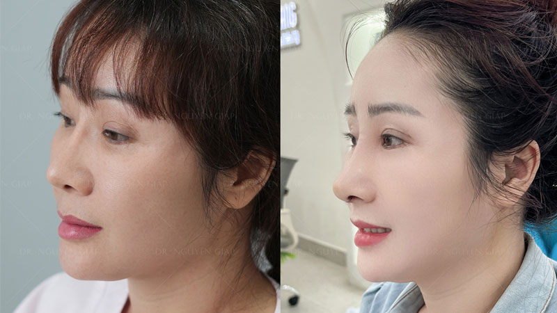 nang-mui-bao-lau-thi-dau-mui-het-to