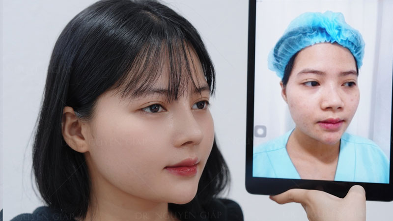 nang-mui-co-de-duoc-ca-doi-khong