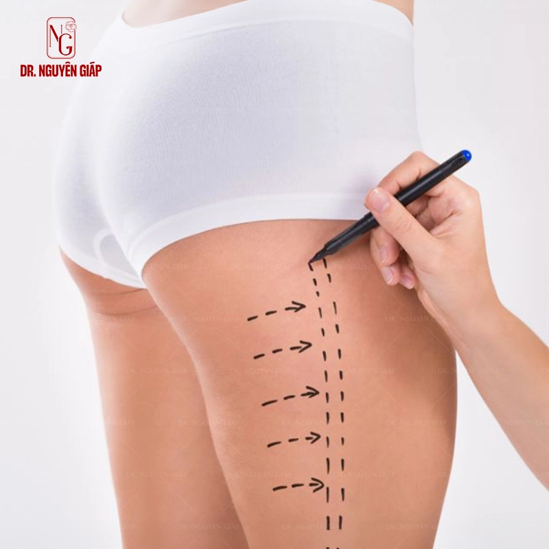 hut-mo-dui-1 Đùi to là nỗi tự ti của nhiều chị em phụ nữ