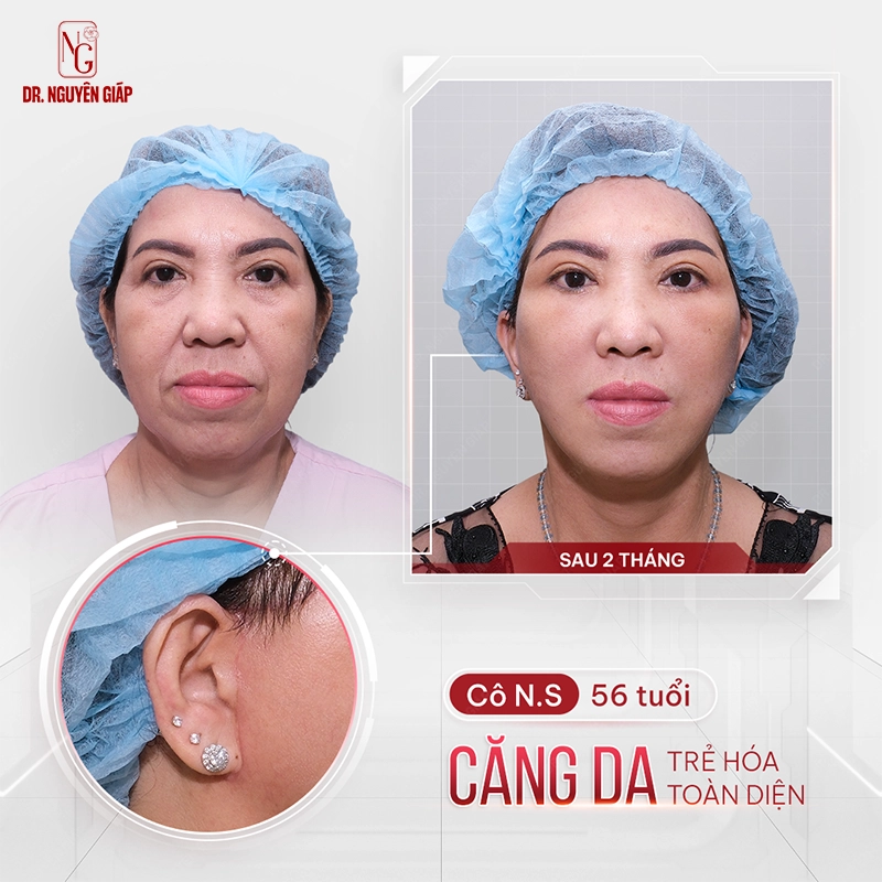 Bao nhiêu tuổi thì nên phẫu thuật căng da mặt? Phẫu thuật căng da mặt giúp lưu giữ tuổi thanh xuân lâu dài