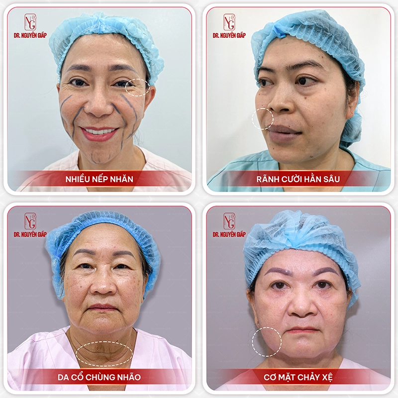 Bao nhiêu tuổi thì nên phẫu thuật căng da mặt? Những dấu hiệu cảnh báo bạn đã tới độ tuổi cần phẫu thuật căng da mặt