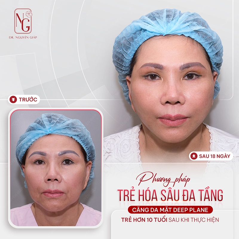 Bao nhiêu tuổi thì nên phẫu thuật căng da mặt? Trẻ trung, an toàn, bên lâu với căng da mặt Deep Plane tại Dr. Nguyên Giáp