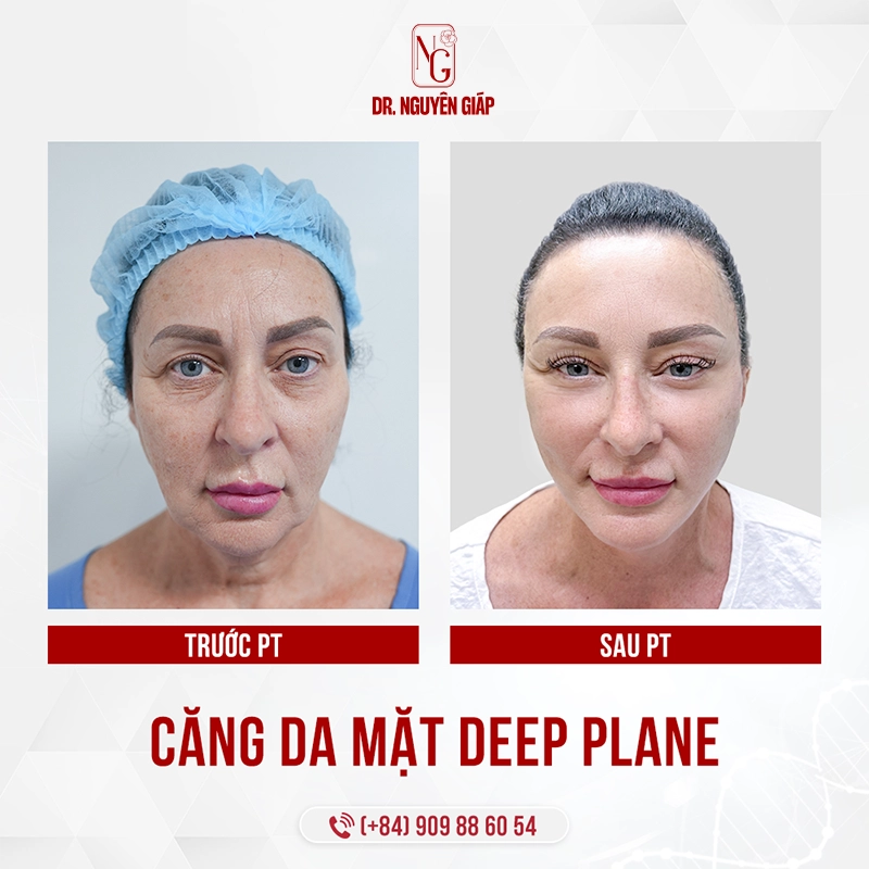 So sánh Căng da mặt Deep Plane và Căng da mặt bằng chỉ Khách hàng nước ngoài đều đặt trọn niềm tin vào dịch vụ căng da mặt deep plane trẻ hóa