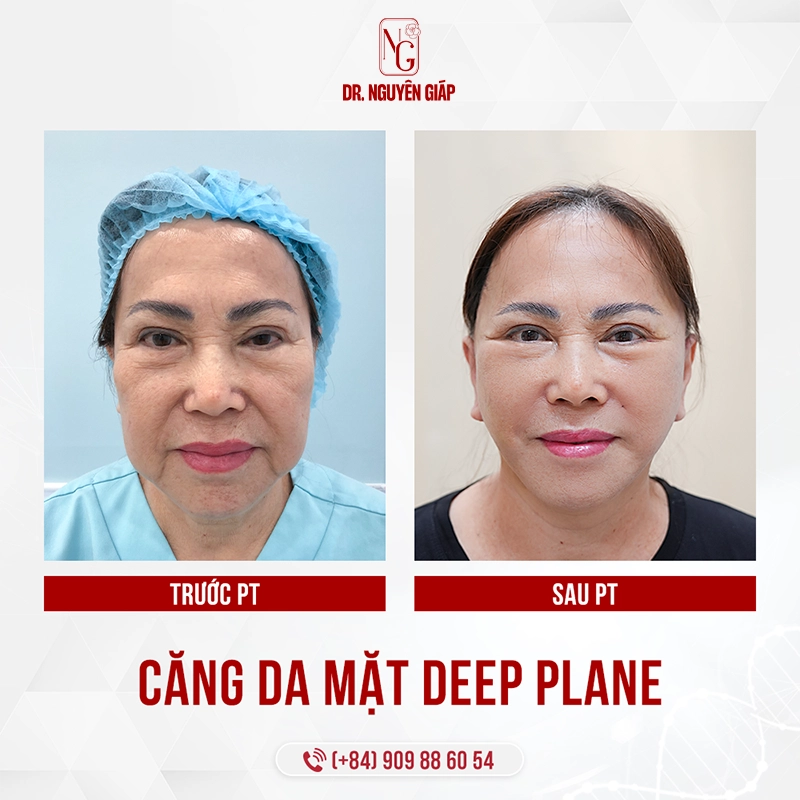 So sánh Căng da mặt Deep Plane và Căng da mặt bằng chỉ Gương mặt rạng rỡ tươi trẻ của khách hàng sau khi thực hiện căng mặt deep plane tại Dr. Nguyên Giáp