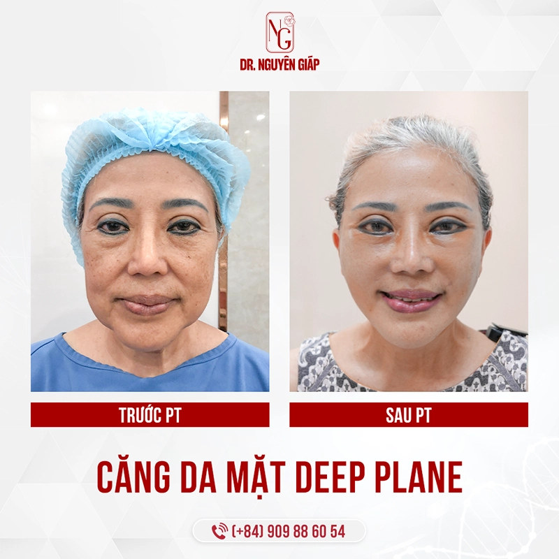 So sánh Căng da mặt Deep Plane và Căng da mặt bằng chỉ Gương mặt rạng rỡ, hạnh phúc sau khi căng da mặt deep plane