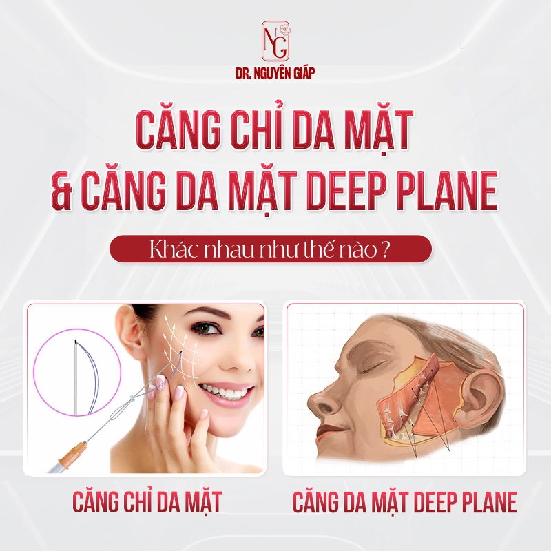 Căng da mặt Deep Plane và căng chỉ có điểm gì khác nhau?