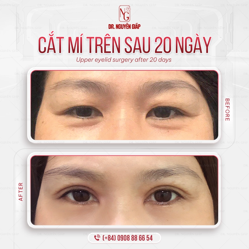 Cắt mắt hai mí chuẩn y khoa Hình ảnh khách hàng cắt mắt hai mí, nếp mí sắc nét cực đẹp