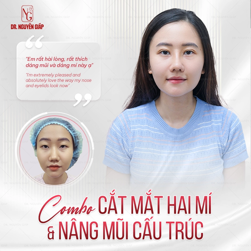Cắt mắt hai mí chuẩn y khoa Feedback khách hàng sau 2 tuần cắt mắt hai mí và nâng mũi cấu trúc tại Dr. Nguyên Giáp