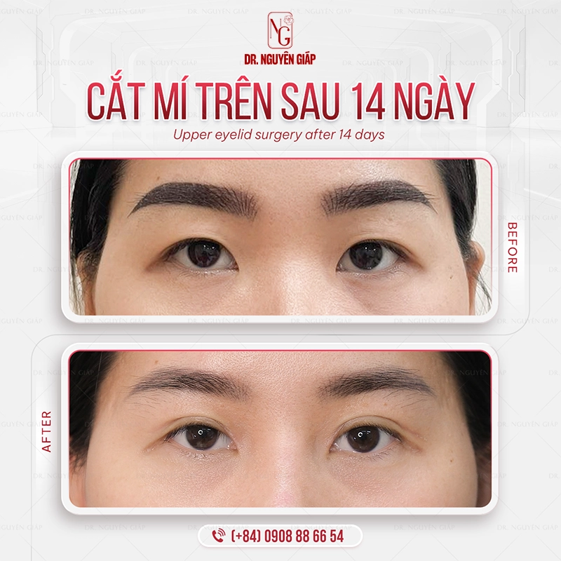 Cắt mắt hai mí chuẩn y khoa Nếp mí tự nhiên, cân đối