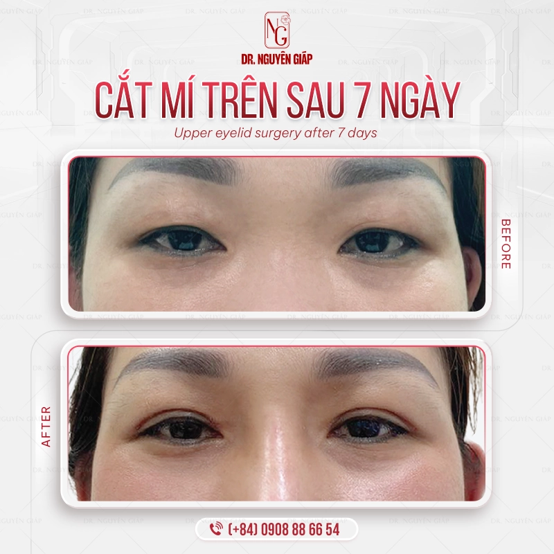 Cắt mắt hai mí chuẩn y khoa Không còn mắt 1 mí, chỉ còn đôi mắt hai mí rõ nét