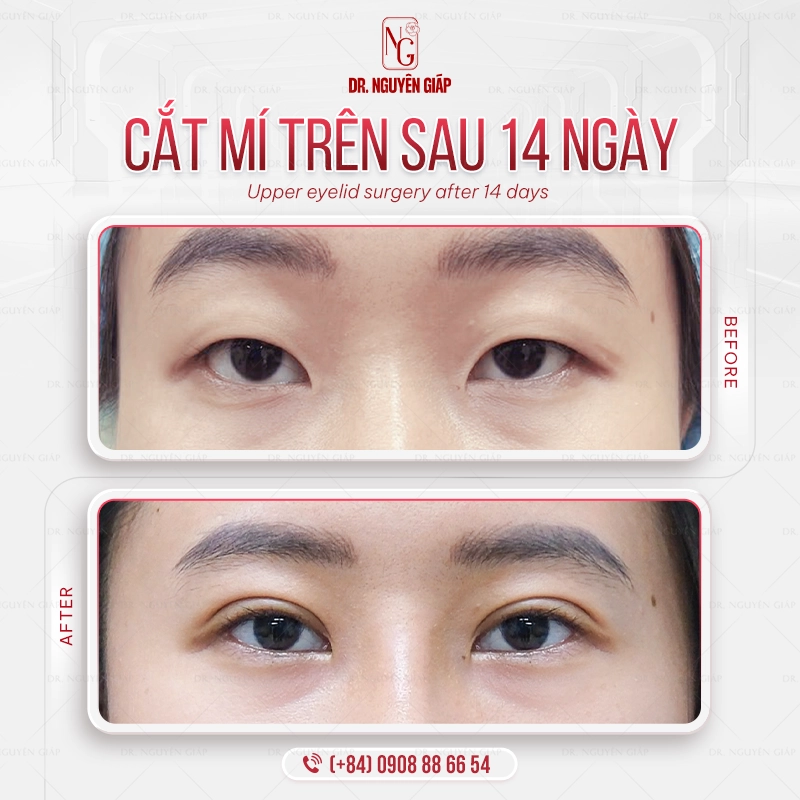 Cắt mắt hai mí chuẩn y khoa Đôi mắt hai mí là điểm nhấn giúp bạn nâng cấp nhan sắc