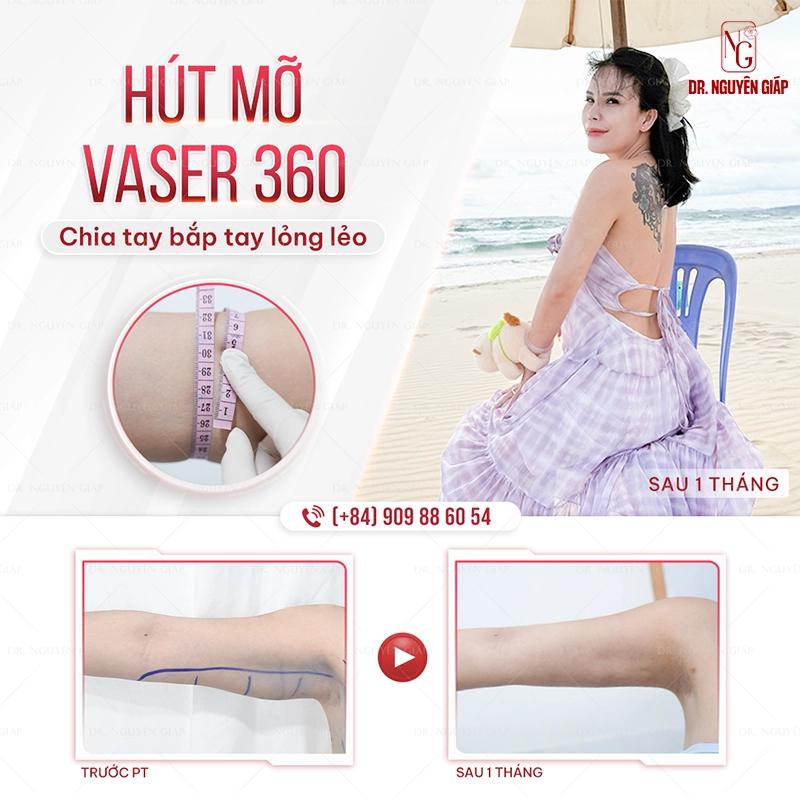Hút mỡ bắp tay công nghệ Vaser 360 hiện đại tại Dr. Nguyên Giáp