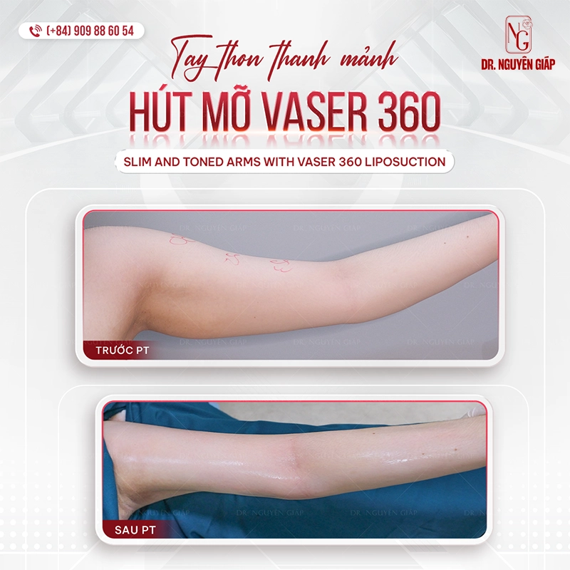 Hút mỡ bắp tay Hut mo Bap Tay 2
