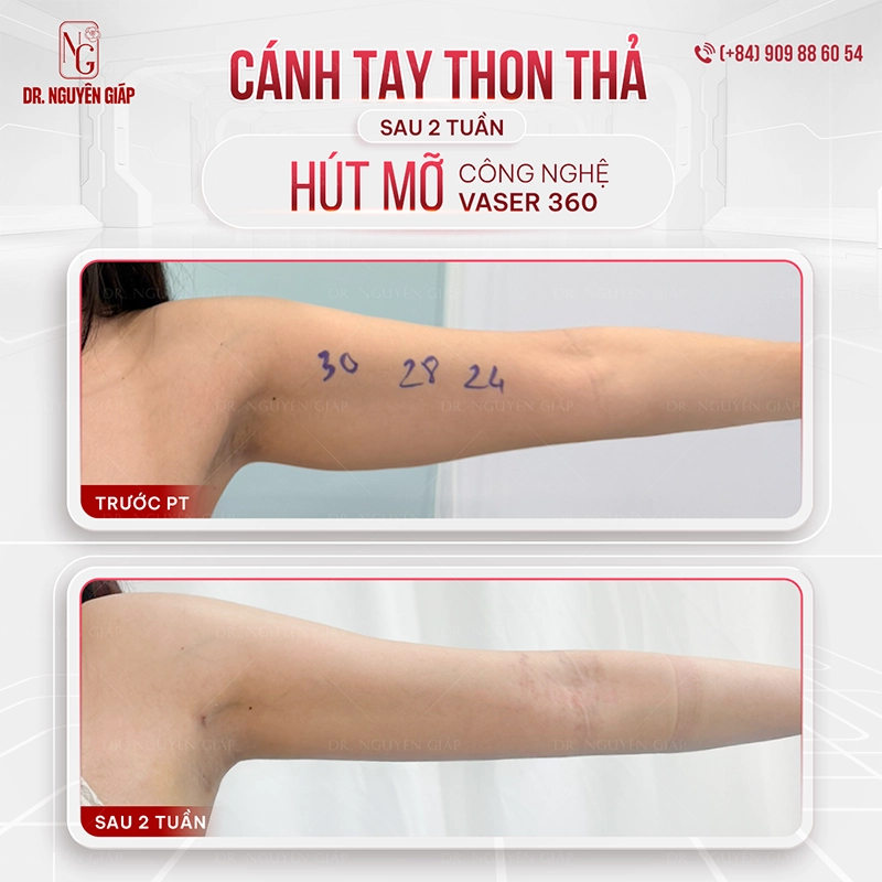 Hút mỡ bắp tay Hut mo Bap Tay 5