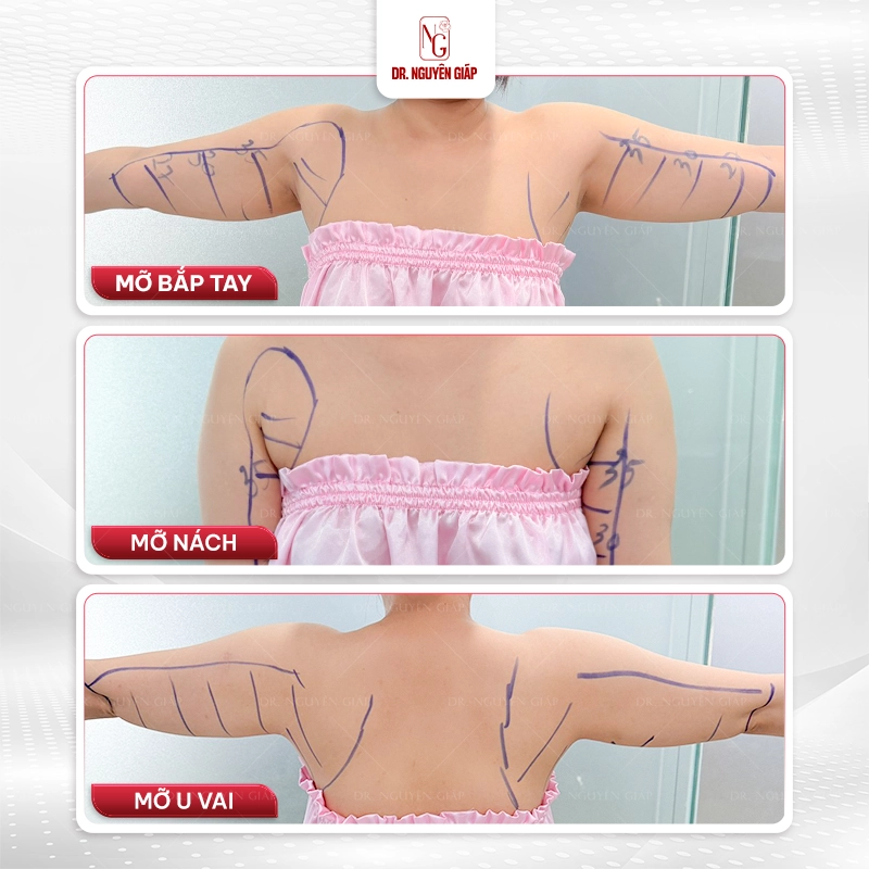 Hút mỡ bắp tay Mỡ bắp tay là nguyên nhân khiến nhiều chị em đau đầu, phiền muộn