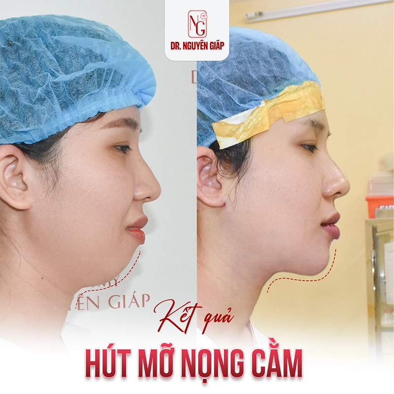 Hút mỡ nọng cằm: Bí mật của gương mặt V-line Hut mo nong cam 1