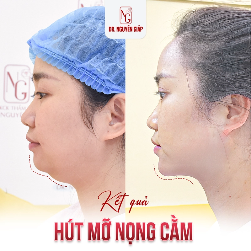 Hút mỡ nọng cằm: Bí mật của gương mặt V-line Hut mo nong cam 2