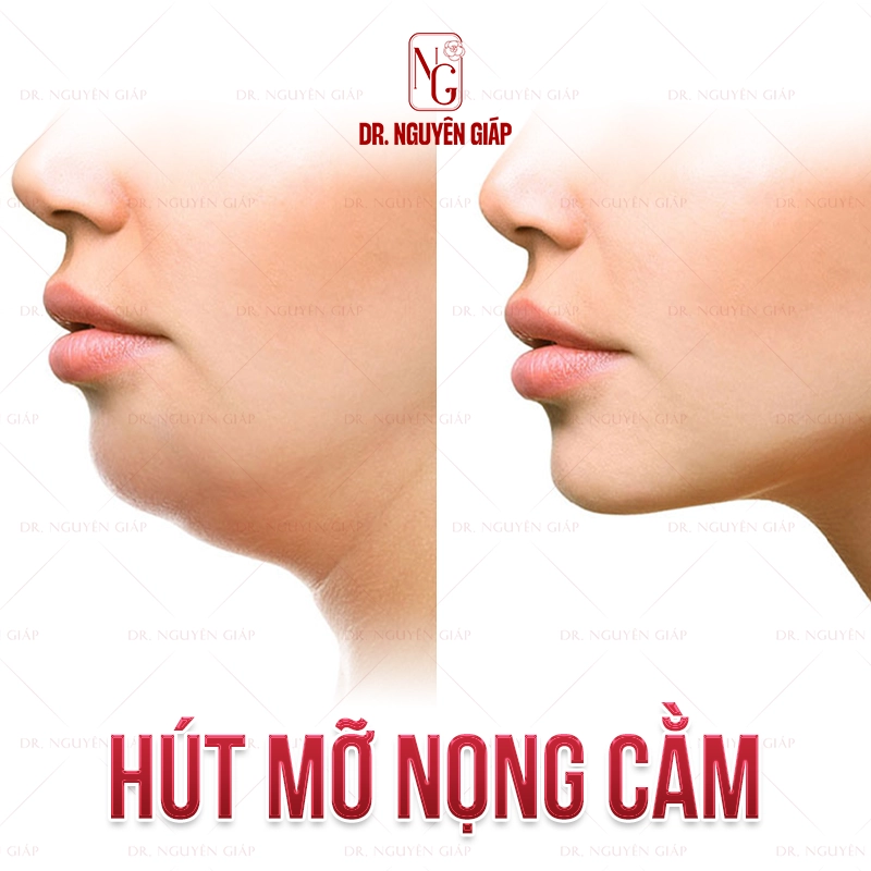 Hút mỡ nọng cằm: Bí mật của gương mặt V-line Hut mo nong cam 3