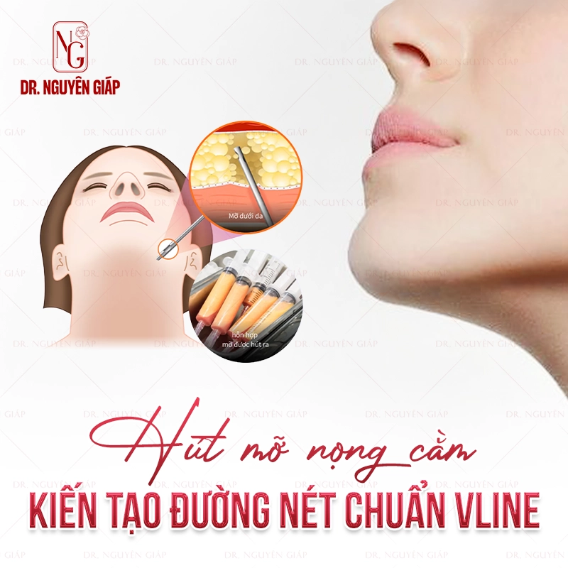 Hút mỡ nọng cằm kiến tạo đường nét Vline sắc nét