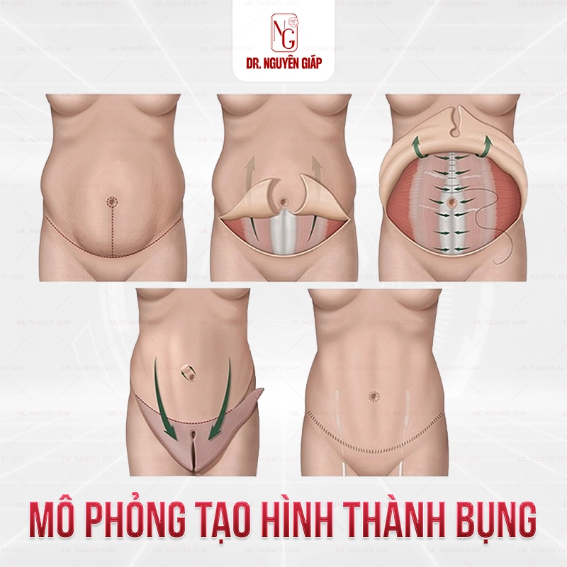 Sự khác biệt giữa hút mỡ và tạo hình thành bụng Mô phỏng tạo hình thành bụng