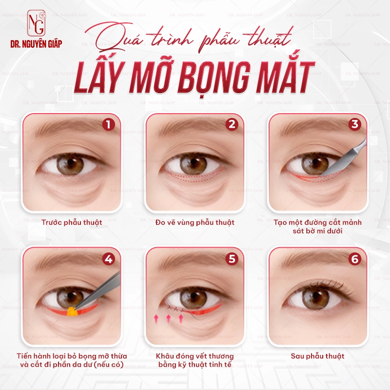 Lấy mỡ bọng mắt: Xóa tan vẻ mệt mỏi tức thì Mô phỏng chi tiết về quá trình lấy mỡ bọng mắt tại Dr. Nguyên Giáp