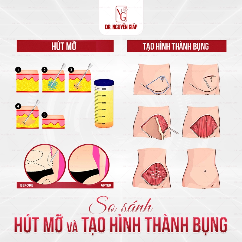 SO SÁNH HÚT MỠ VÀ TẠO HÌNH THÀNH BỤNG
