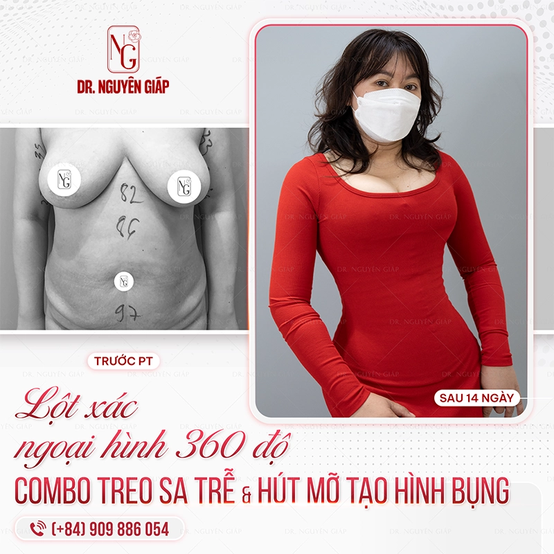 Sự khác biệt giữa hút mỡ và tạo hình thành bụng Tao hinh thanh bung 2