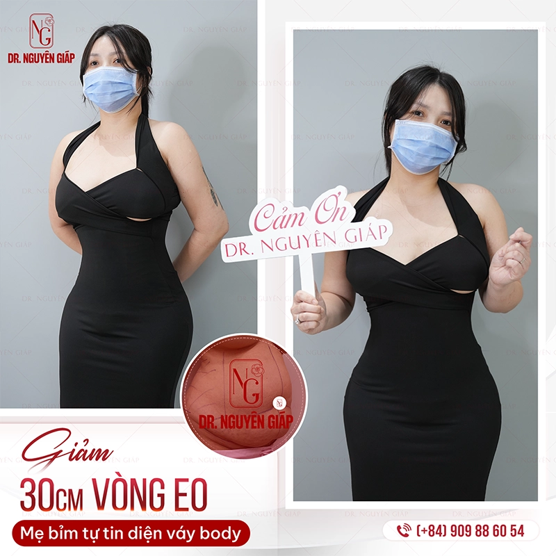 Sự khác biệt giữa hút mỡ và tạo hình thành bụng Tao hinh thanh bung 4