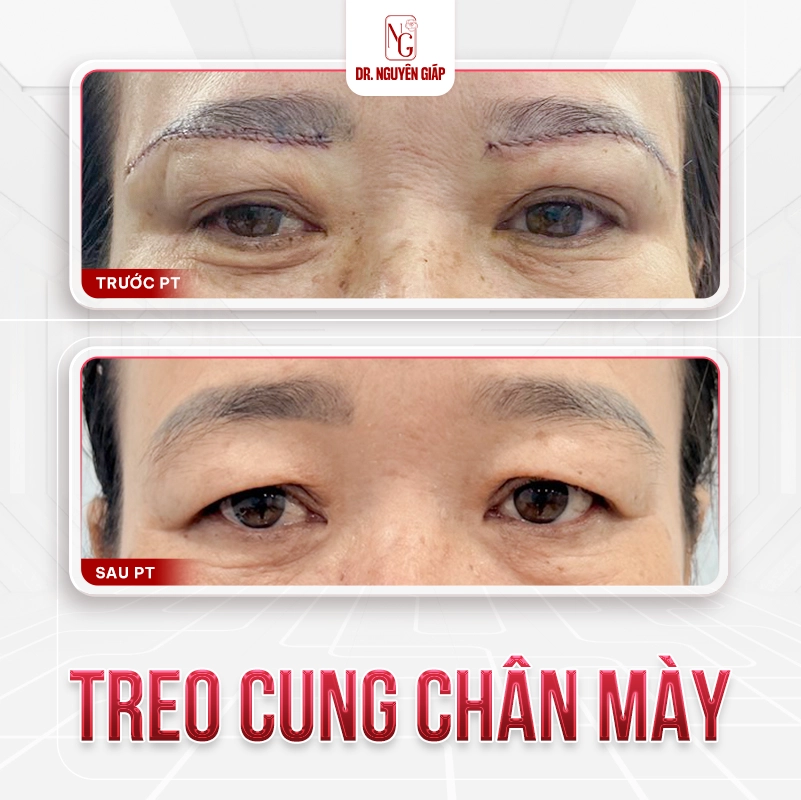 Treo cung may 2