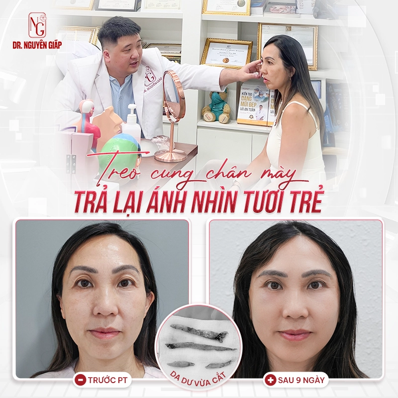 Treo cung mày trả lại ánh nhìn tươi trẻ