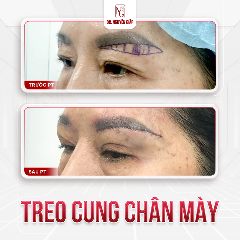 Treo cung may 4