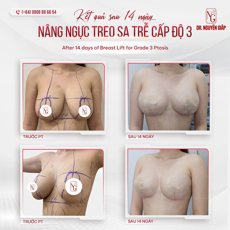 Treo sa tre nguc 4