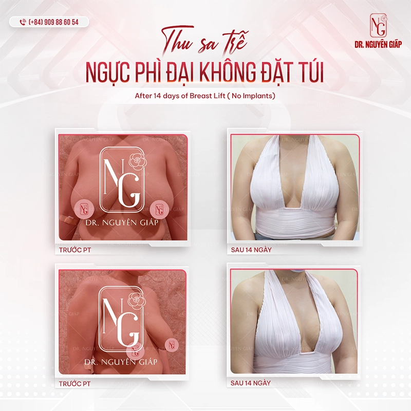 Treo sa tre nguc 5