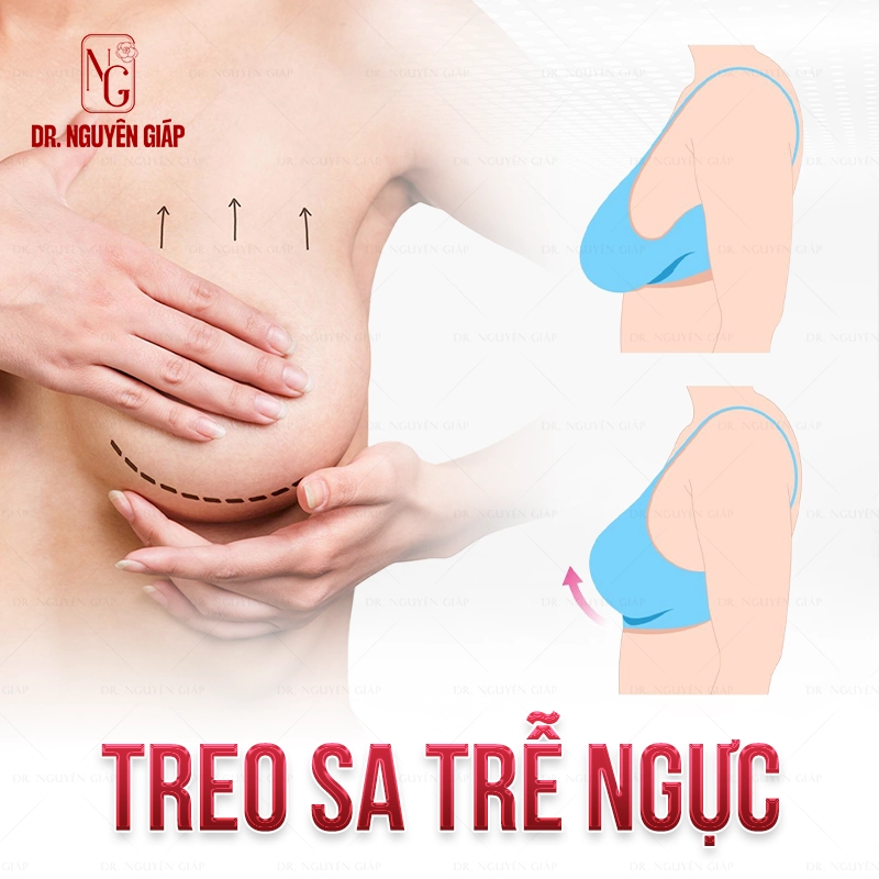 Treo sa trễ ngực giúp người phụ nữ tự tin hơn