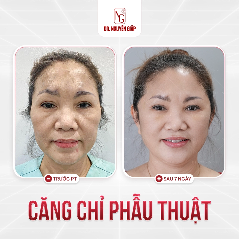 cang-chi-collagen-2 Khách hàng căng chỉ collagen phẫu thuật tại Dr. Nguyên Giáp